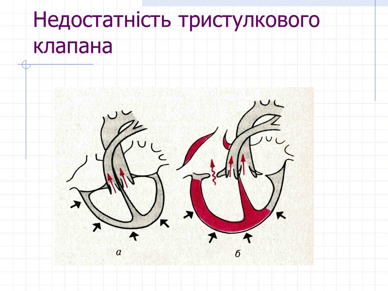 Недостатність тристулкового клапана